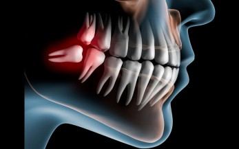 Schema dei denti del giudizio su una radiografia