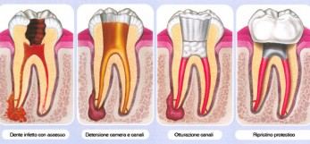 Schema dei denti con le fasi della cura endodontica
