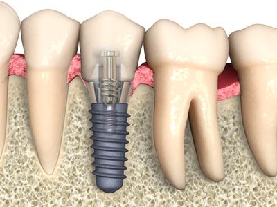 Schema di un impianto dentale in titanio