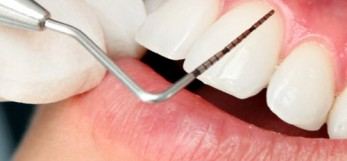 Una sonda parodontale tra i denti
