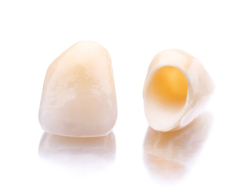 Due corone dentali in ceramica